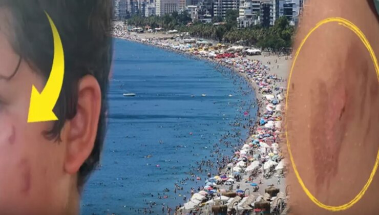 Vatandaşlar tedirgin! Denize giren yanıklarla çıkıyor