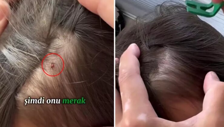 Baba, kızının kafasına yapışan keneyi böyle kopardı