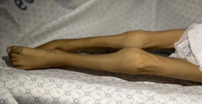 Gazze Şeridi’nde bir çocuk daha "açlıktan" öldü! 3 kiloya kadar düşmüştü