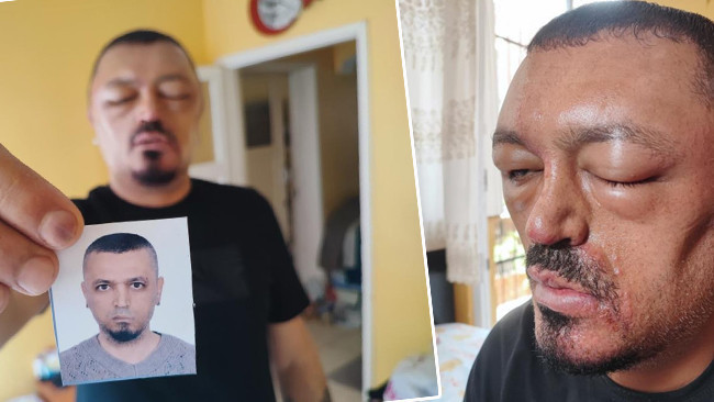 Berberi önerdi internetten satın aldı! 48 saat sonra hayatı kabusa döndü | ‘Gözlerimi kaybedeceğim diye çok korktum’
