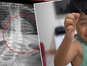 Salatalık parçası yuttu hastaneye gitti! Çekilen röntgenle ortaya çıktı! 18 santimetrelik kateterin unutulmuş