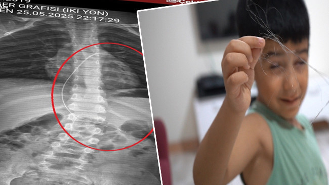 Salatalık parçası yuttu hastaneye gitti! Çekilen röntgenle ortaya çıktı! 18 santimetrelik kateterin unutulmuş