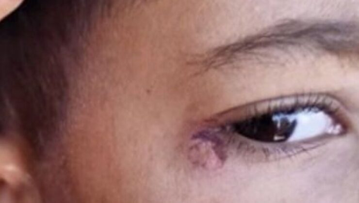 Kan donduran olay… Öğrencinin yüzünde sigara söndürdü!